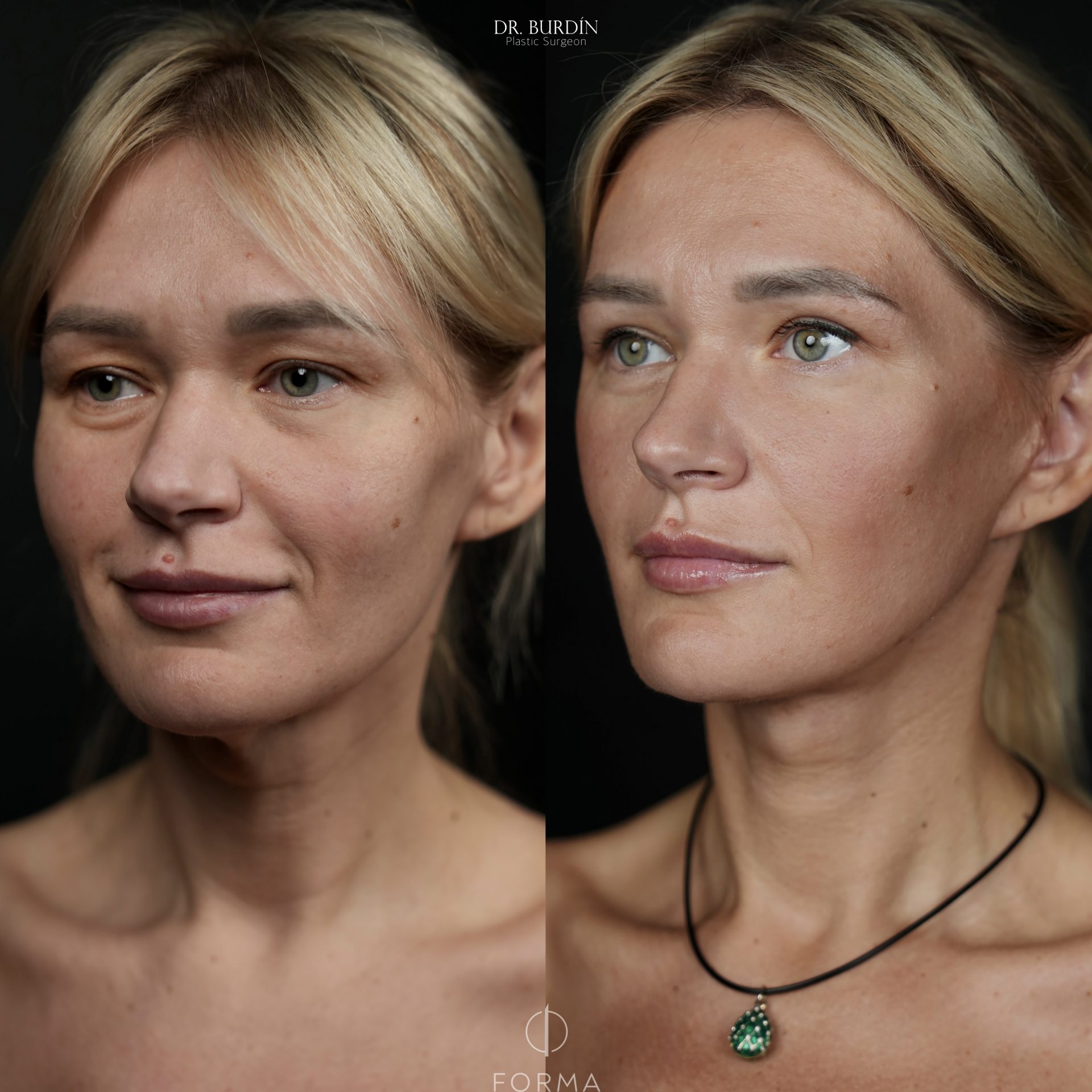 Фото до и после SMAS-лифтинг лица и шеи врач Сергей Бурдин