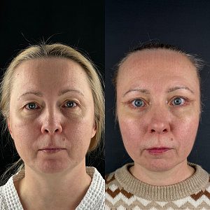 Фото до и после Блефаропластика врач Анна Герасимова