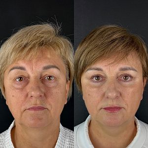 Фото до и после Блефаропластика врач Анна Герасимова
