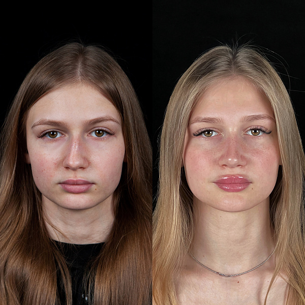 Фото до и после Первичная ринопластика врач Елена Бурдина